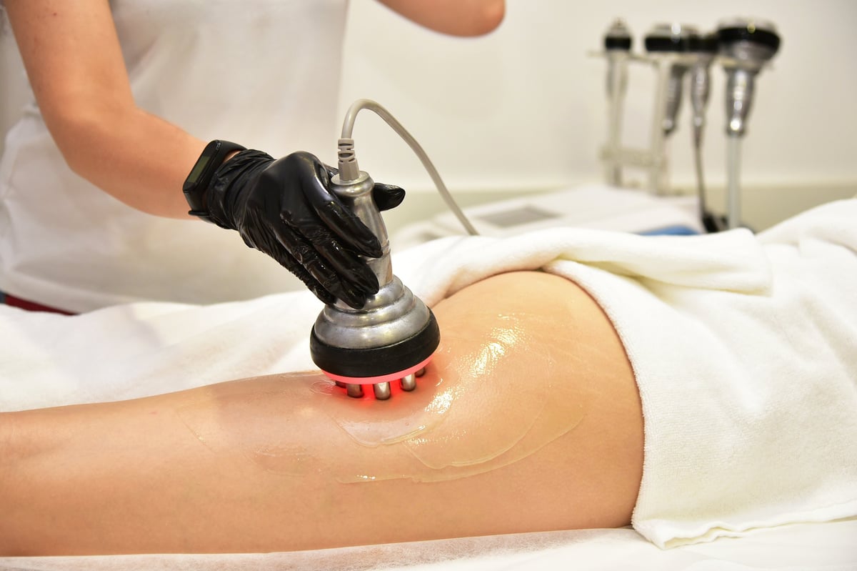 RF skin tightening and ultrasound cavitation body contouring treatment showing multiple body areas