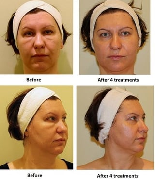 Before and after comparison of facial cosmetic treatment results