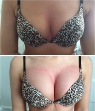 Before and after photos showing breast enhancement results