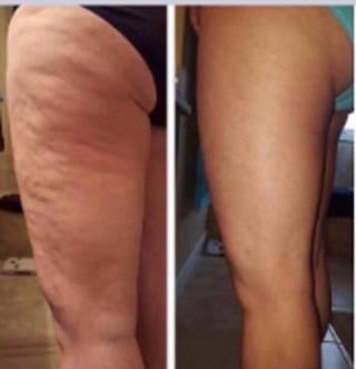 Before and after comparison showing reduced cellulose on thigh