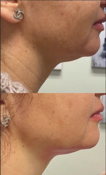 Before and after comparison of neck skin texture showing improved smoothness and tone