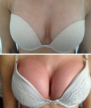 Before and after comparison of breast enhancement results