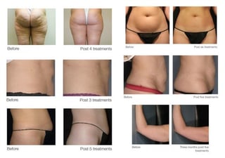 Before and after body skin treatment results
