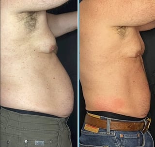 Before and after body transformation comparison showing abdominal weight loss and improved muscle definition