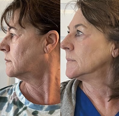 Before and after side profile of neck and jawline showing a firmer-looking appearance