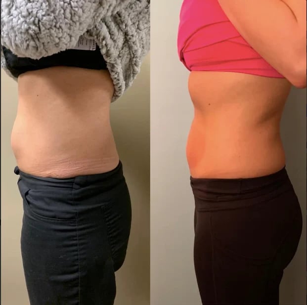 Before and after body contouring comparison showing abdominal results from slimming treatment