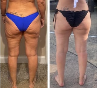 Before and after comparison of legs