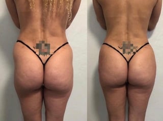 Before and after body contouring results showing back view