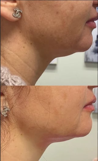 Before and after comparison of chin and jawline