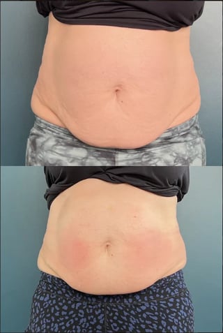 Before and after abdominal body comparison showing improved appearance