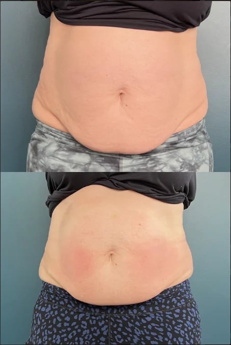 Before and after body contouring comparison showing waist reduction results